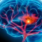 Mŕtvica: Náhly útok na mozog